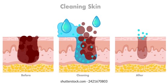 Skin cleaning, facial skin care, pore cleaning stages clogged facial. absorb, rejuvenation wrinkles. Human facial fillers. Water moisturizer. Dermatology, skincare, anti aging. Vector illustration