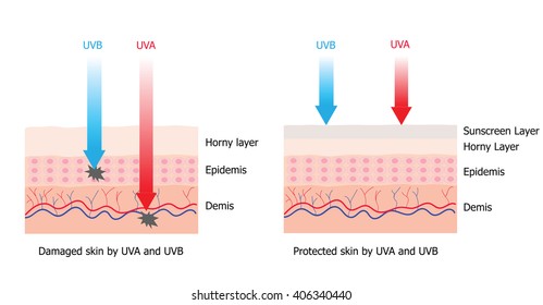 Skin compare between skin with spectrum-boarding sunscreen which protect UVA and UVB  to skin without sunscreen and have damage cell 