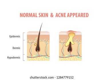 Skin comparing with Normal Skin & Acne Appeared condition diagram illustration vector on white background. Beauty concept.