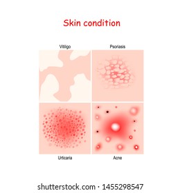 Trastornos de la piel y enfermedades. Cierre de Acné, Urticaria, Psoriasis, Vitiligo. diagrama vectorial para la educación, la medicina y la ciencia