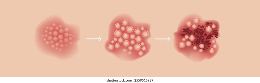 Skin Conditions of Shingles Early Stage