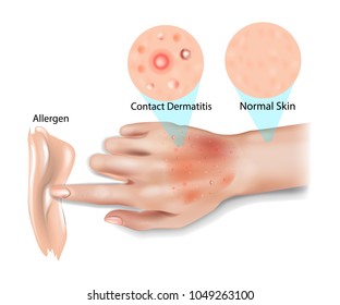 Skin Contact Dermatitis, Allergic contact dermatitis, Irritant contact dermatitis,  Phototoxic dermatitis 