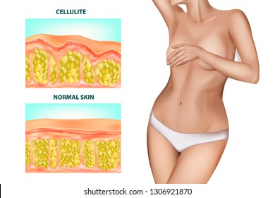 Skin cross section of Cellulite formation. Banner with the realistic beautiful women without cellulite