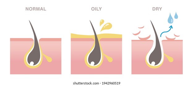 Skin cross section of pore types. Normal, oily, and dry pores. Pale colored illustration in flat cartoon style.