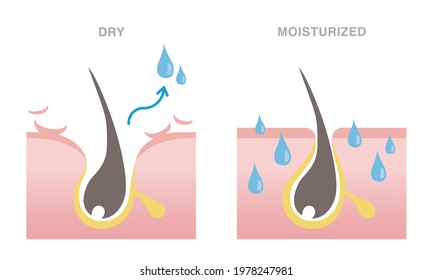 Skin cross section of pore types. Moisturized pore and dry pore. Pale colored illustration in flat cartoon style.