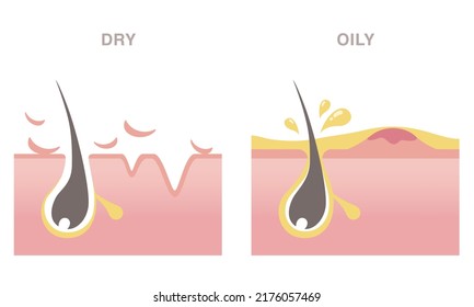 Skin cross section of pore types. Acne on oily skin, wrinkles on dry skin. Pale colored illustration in flat cartoon style.