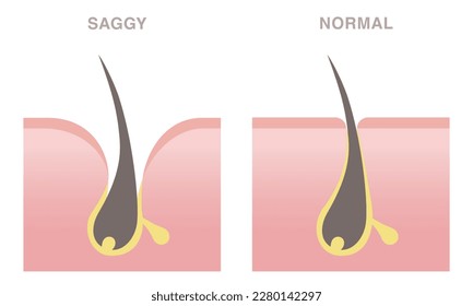 Skin cross section of pore types. Normal pore and saggy pore. Pale colored illustration in flat cartoon style.