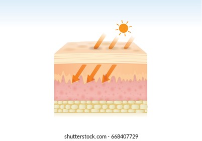 Skin damaged by the absorption of energy from UV rays. Illustration about medical and health care.