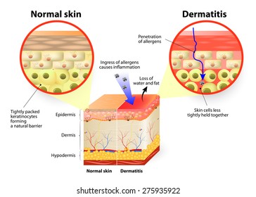 Skin Disease. Dermatitis Or Eczema. Labeled Diagram