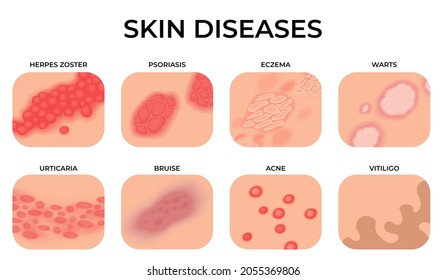 Skin disease. Different diseases, epidermis surface with eczema. Dermatology, allergy symptoms. Human body psoriasis, medical recent vector set
