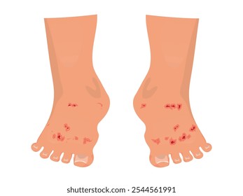 skin disease on the foot, Tinea pedis or athlete's foot. vector illustration.