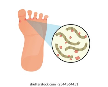 skin disease on the foot, Tinea pedis or athlete's foot. vector illustration.