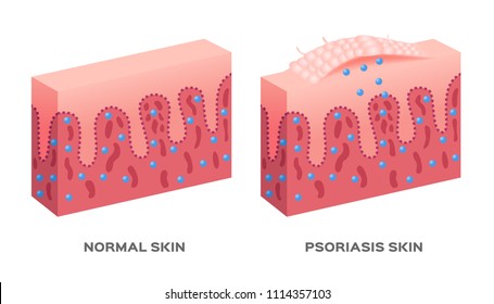 Skin Disease Vector / Psoriasis