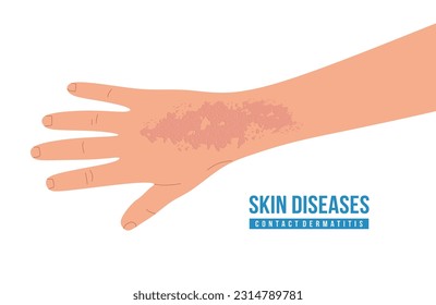 Skin diseases, contact dermatitis. Hand with scratches. Concept of healthcare and medicine. Skin irritation Flat vector illustration