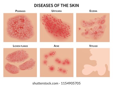 Skin diseases. Derma infection, eczema and psoriasis. Dermatology vector illustration. Disease medical epidermis, dermatitis infection