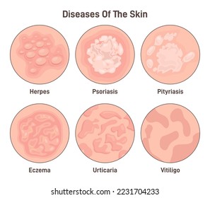 Skin diseases set. Derma infection, eczema and psoriasis. Dermatology problem, disruption of the epidermis structure. Flat vector illustration