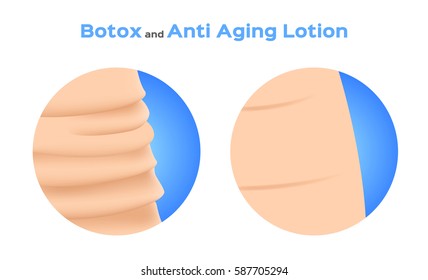 skin filler vector . It can cure the wrinkle 