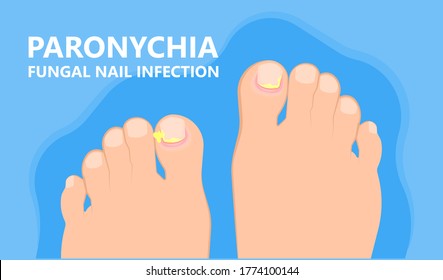 Skin Finger Nail Toes Symptom Injuries Pus Drain Treatment Treat Fluid Relieve Heal Wound Fungal Surgery Hand Feet Fungus Felon Onychia Clubbing Abscess Thick Ragged Crack Bed Fungi Athlete's Foot