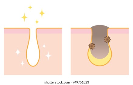 skin illustration of before and after unclogging pore treatment