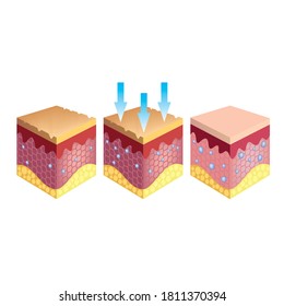 Skin Illustration Cross Sectional View Rehydration Stock Vector ...