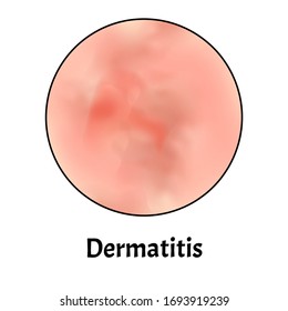 Inflamación de la piel. Dermatitis cutánea. Infografía. Ilustración vectorial en fondo aislado.