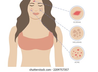 Skin Issues Eczema, Acne And Melasma. Skin Problems With Woman Illustration