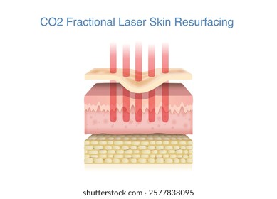 Skin layer with  acne scar treated by CO2 fractional laser into middle layer. 3D illustration about technology for healing scar and reduce wrinkles.
