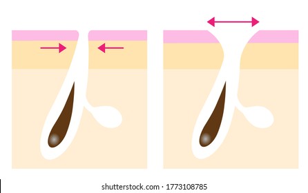 skin layer of enlarged pores before after illustration. Facial and body care concept