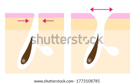 skin layer of enlarged pores before after illustration. Facial and body care concept