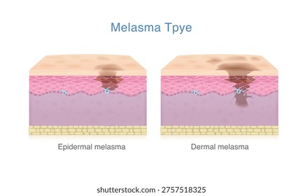 Skin layer with Epidermal melasma and Dermal melasma. Medical diagram about the different types of anatomy of skin pigment with dark spots problem and skin uneven.