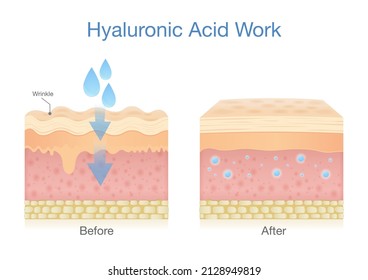 Skin layer getting Hyaluronic Acid increases skin moisture and reduces the appearance of fine lines and wrinkles.
