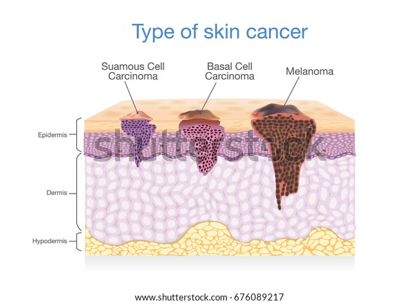 Skin layer have 3 Type of Cancer in one.\
Illustration about Medical\
diagram.