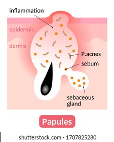 skin layer of papules. type of inflamed acne blemish which is red bump on the skin. skin care concept