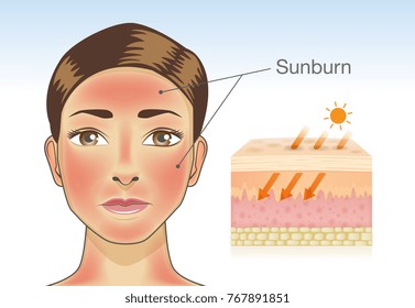 Skin layer of woman which appear redness on facial and neck from sunburn. Illustration about danger of Ultraviolet radiation.