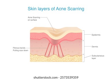 Skin layers of Acne scarring. Under scar in the dermis layer have fibrous bands pulling scar down. Anatomy of human facial skin with acne scar.