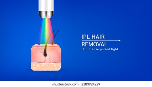 Skin layers anatomy with hairs. IPL light (Intense Pulsed Light) hair removal. Unwanted out make skin smooth. Banner used for beauty advertisements. Medical science concept. 3D Realistic vector EPS10.