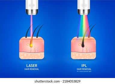 Skin layers anatomy with hairs. Laser and IPL light (Intense Pulsed Light) hair removal. Unwanted out make skin smooth. Used for beauty advertisements. Medical science concept. 3D Realistic vector.
