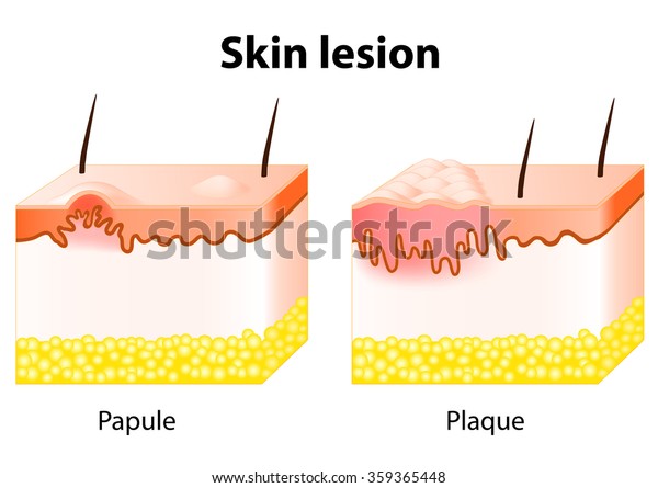 Skin Lesions Type Macule Papule