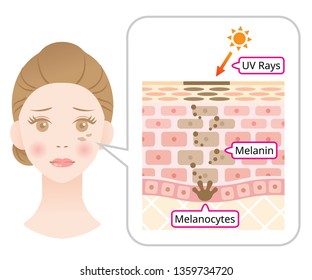 skin mechanism of melanin and facial dark spots. Infographic illustration of woman face and skin layer. Beauty skin care concept
