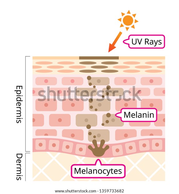 メラニンと顔の黒い斑点の皮膚メカニズム 人間の肌のイラスト 美容 肌のケアのコンセプト のベクター画像素材 ロイヤリティフリー