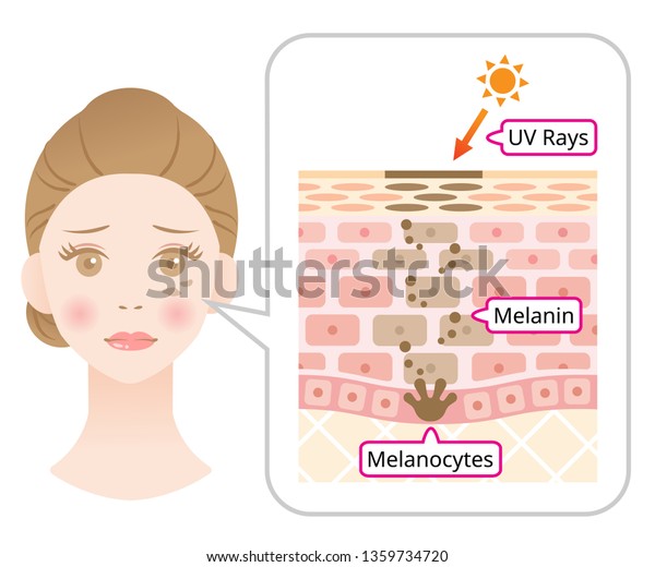 skin mechanism of melanin and facial dark\
spots. Infographic illustration of woman face and skin layer.\
Beauty skin care\
concept\
