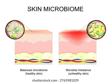 Skin microbiome. Close-up of Microbial imbalance and Balanced microbiome. Сomparison of  healthy and unhealthy skin. Loss of moisture in human skin. Vector illustration. Medical diagram.