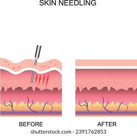 Skin needling. Before and After. Microneedling procedure.