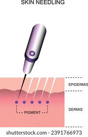 Skin needling. Skin layers. Microneedling guide.