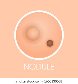 Skin Nodule Pimples Acne Type Face Pore Comedones Cosmetology Skincare Problems Concept Flat Vector Illustration