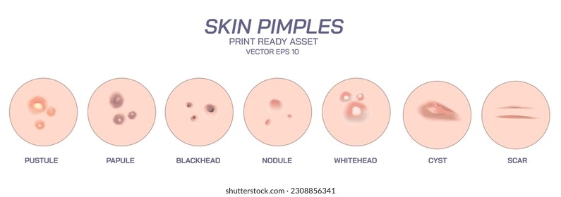 Skin Pimples and acne vector illustration. Appearance of the different pimples of human skin. blackheads, whiteheads, papule, pustule, cystic, nodule, scar. Print ready vector file.