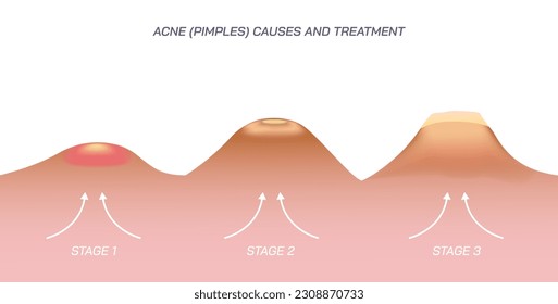 Skin Pimples and acne vector illustration. Appearance of the different pimples of human skin. blackheads, whiteheads, papule, pustule, cystic, nodule, scar. Print ready vector file.