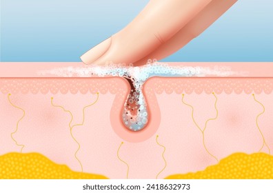 Skin pore cleaning realistic 3d vector cross-section view reveals finger removes debris and excess oil with foam, showcasing a cleansed epidermal layer for a refreshed and revitalized complexion