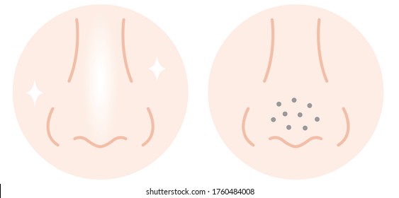 Skin Pores On Human Nose Before And After Illustration. Normal Pores And Blackhead Pores,  Beauty Skin Care Concept