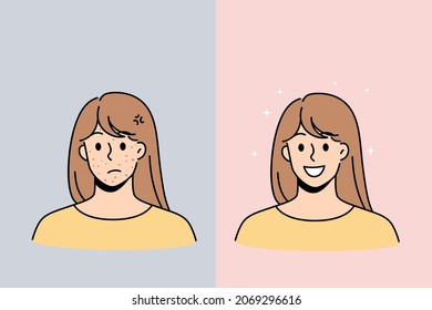 Skin problem and health concept. Stressed unhappy young woman with red acne pimples and smiling with healthy skin face vector illustration 